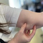 IMPLANON – Foto SESA